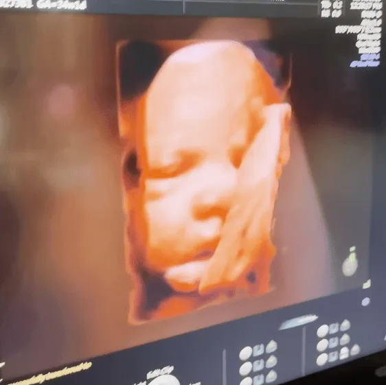 A 3D ultrasound scan of an unborn baby's face.